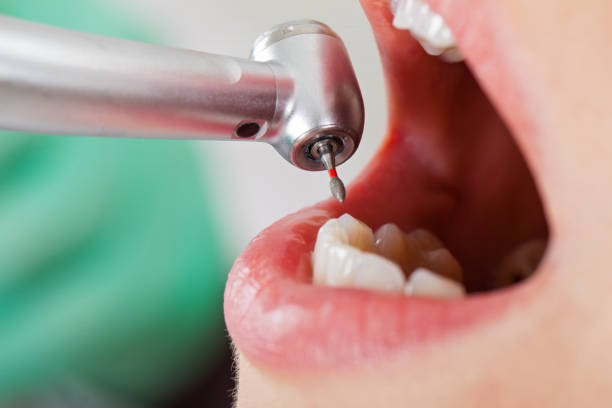 Best Emergency Dental Care for Abscessed Tooth in East Riverdale, MD